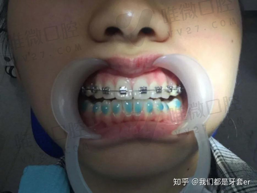 活动义齿和假牙区别在哪,活动义齿好不好(图1)